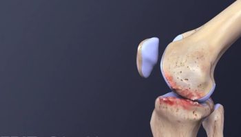 Viêm Khớp Dạng Thấp